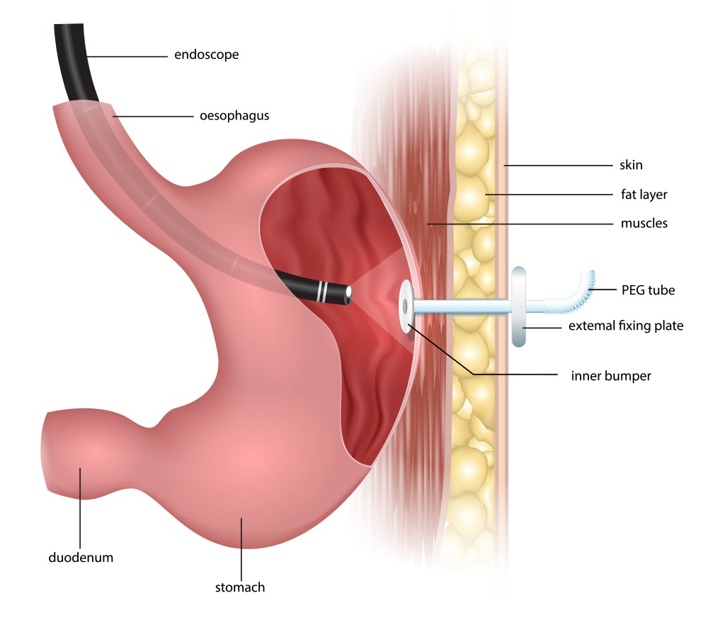 Diagram showing the stomach and PEG tube. 